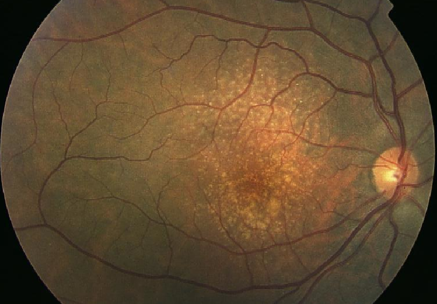 Cos’è la retinopatia maculare – Patologia ed esami