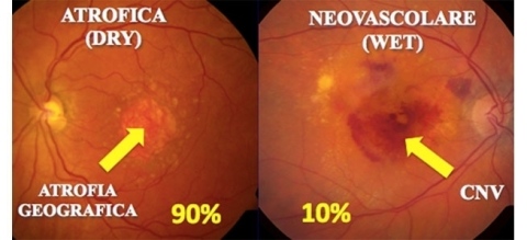 atrofica e neovascolare