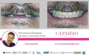 caso clinico implantologia dentale