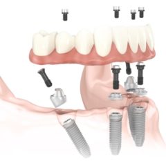 Implantologia dentale: parliamo di costi